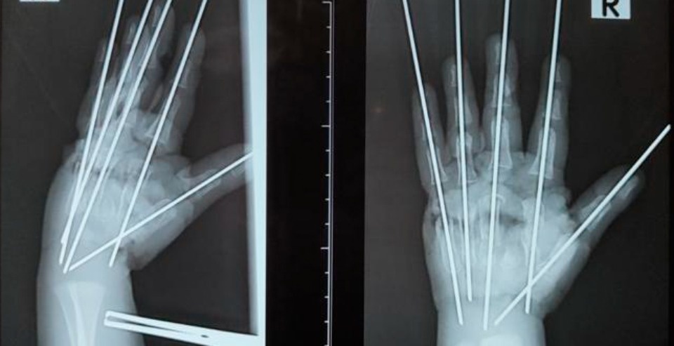 Двухлетнего псковича, рука которого попала в электромясорубку, прооперировали в Санкт-Петербурге Двухлетнего псковича, рука которого попала в электромясорубку, прооперировали в Санкт-Петербурге