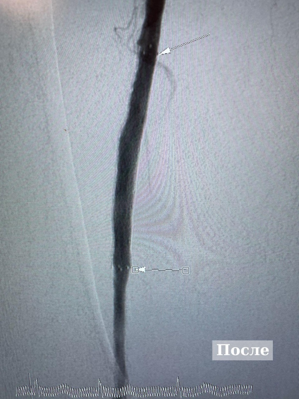 90-летней пациентке провели высокотехнологичную операцию на артериях в Великих Луках 