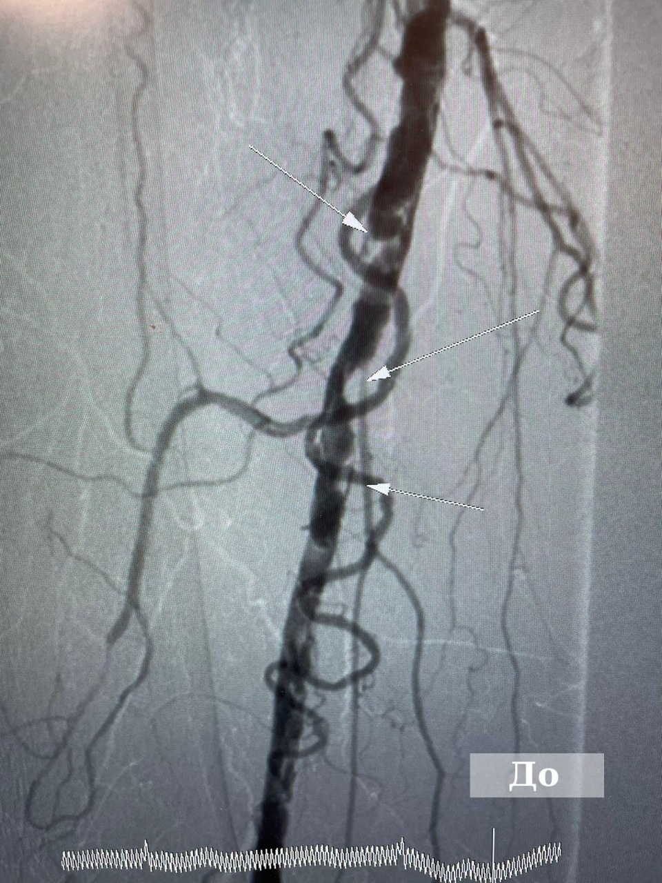 90-летней пациентке провели высокотехнологичную операцию на артериях в Великих Луках 