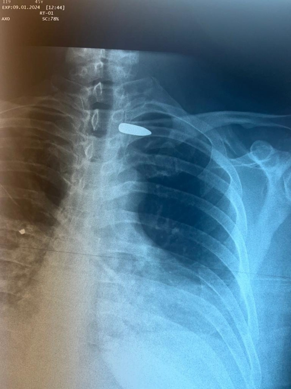 В Псковской областной больнице прооперировали мужчину с осколочными и пулевыми ранениями