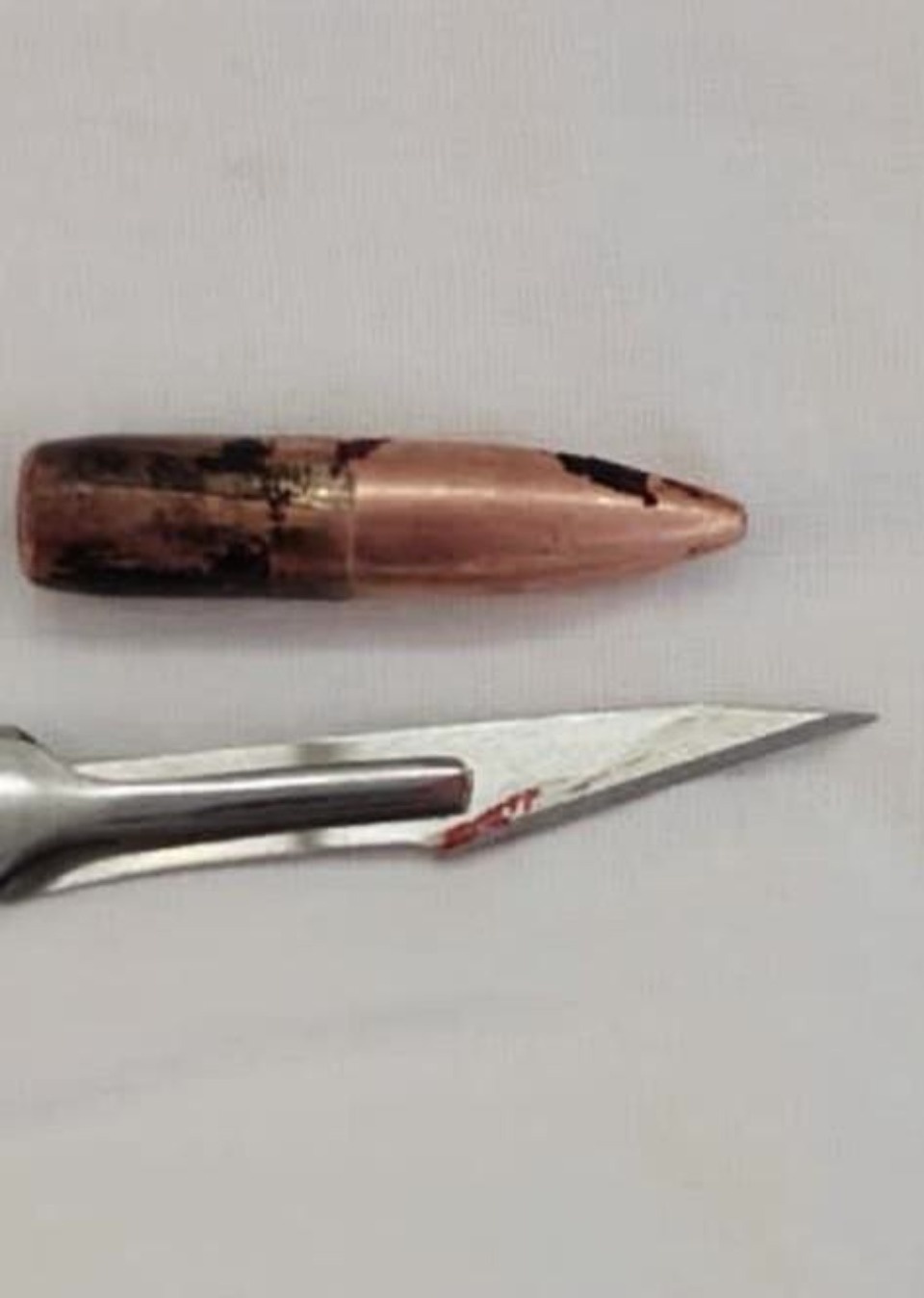 В Псковской областной больнице прооперировали мужчину с осколочными и пулевыми ранениями