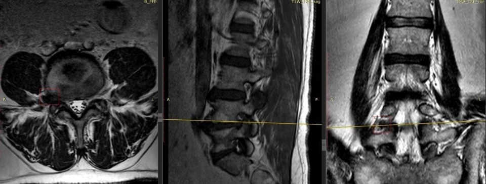 В Пскове провели нестандартную операцию по удалению грыжи 