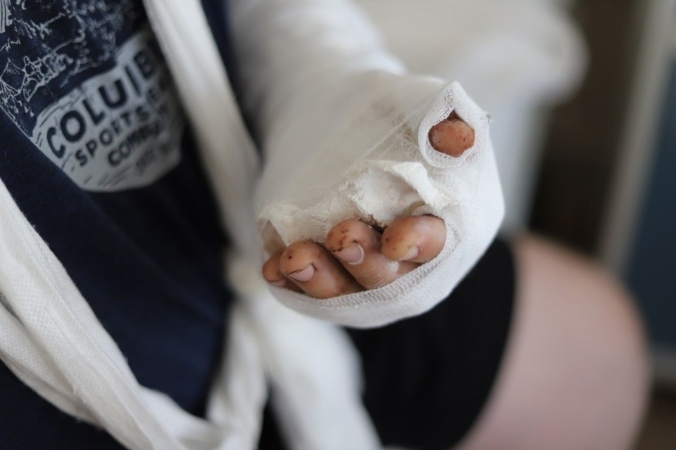 Врачи спасли псковичу кисть руки, которую он отрезал во время ремонта