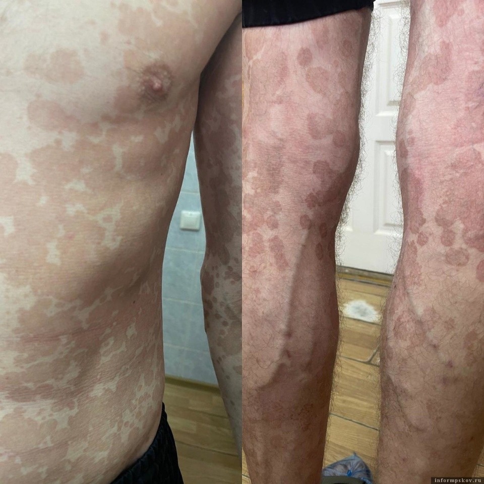 Сразу два псковича с отрубевидным лишаем обратились в кожвендиспансер 