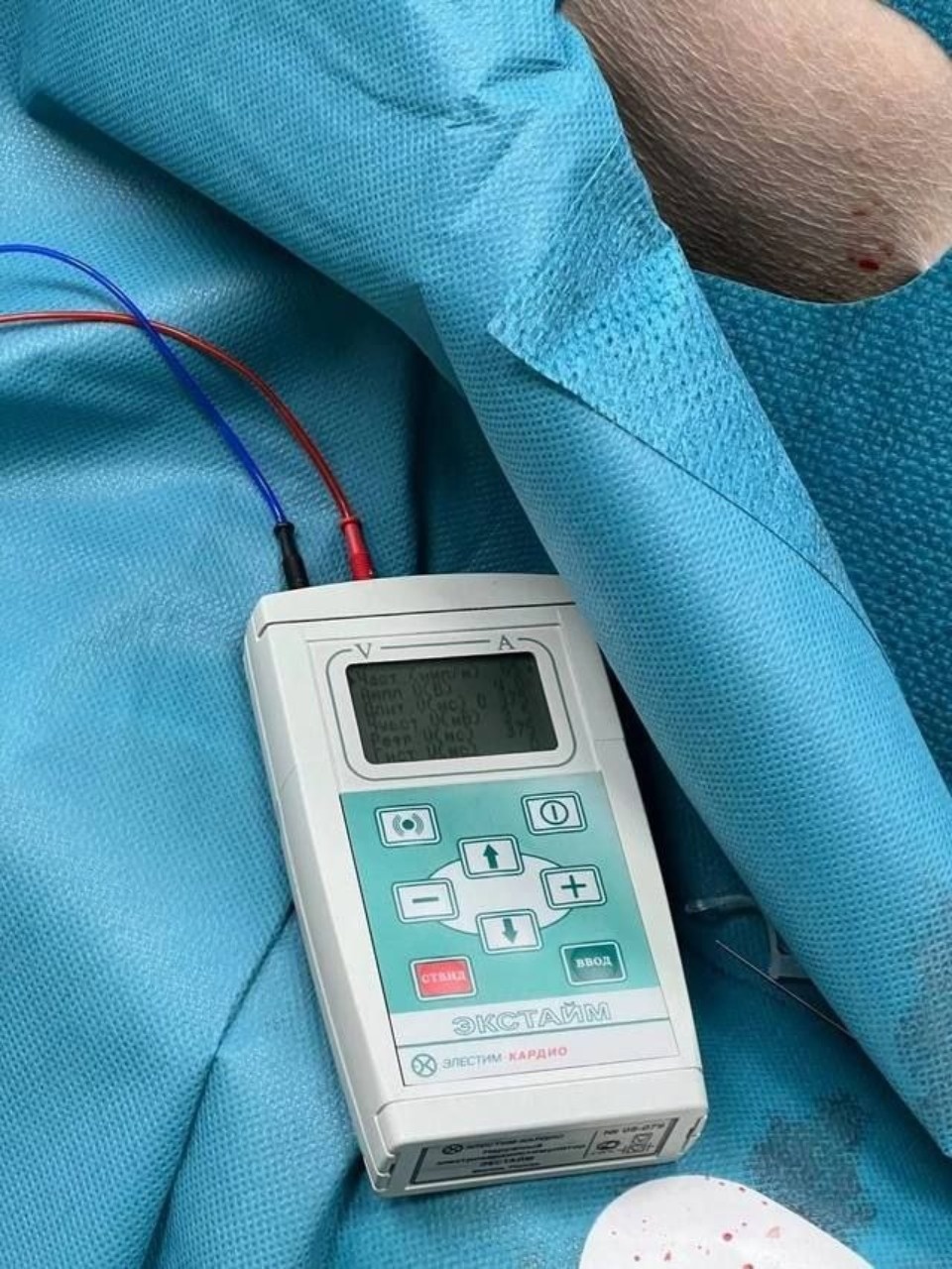 Установка временного кардиостимулятора спасла жизнь пожилому великолучанину