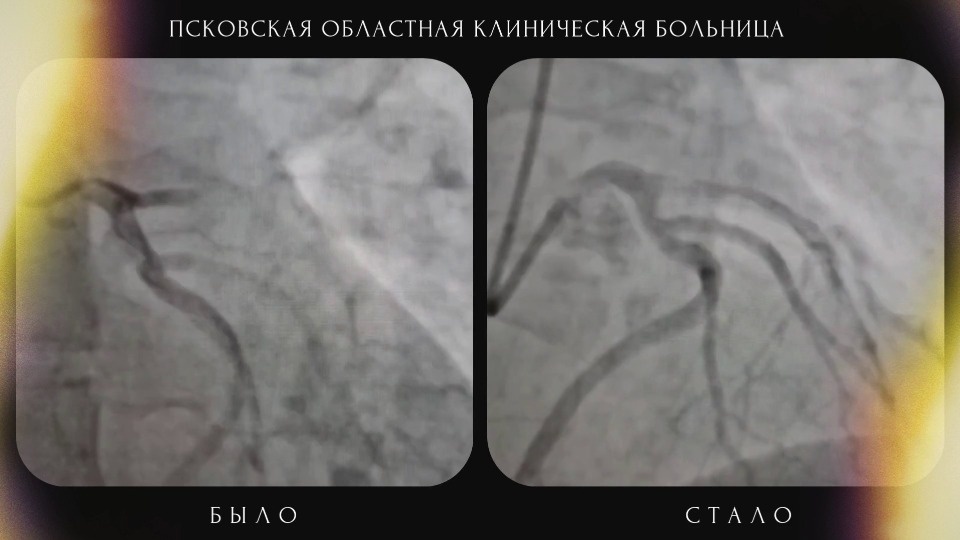 Медики прооперировали беременную пациенту с инфарктом в Пскове Медики прооперировали беременную пациенту с инфарктом в Пскове