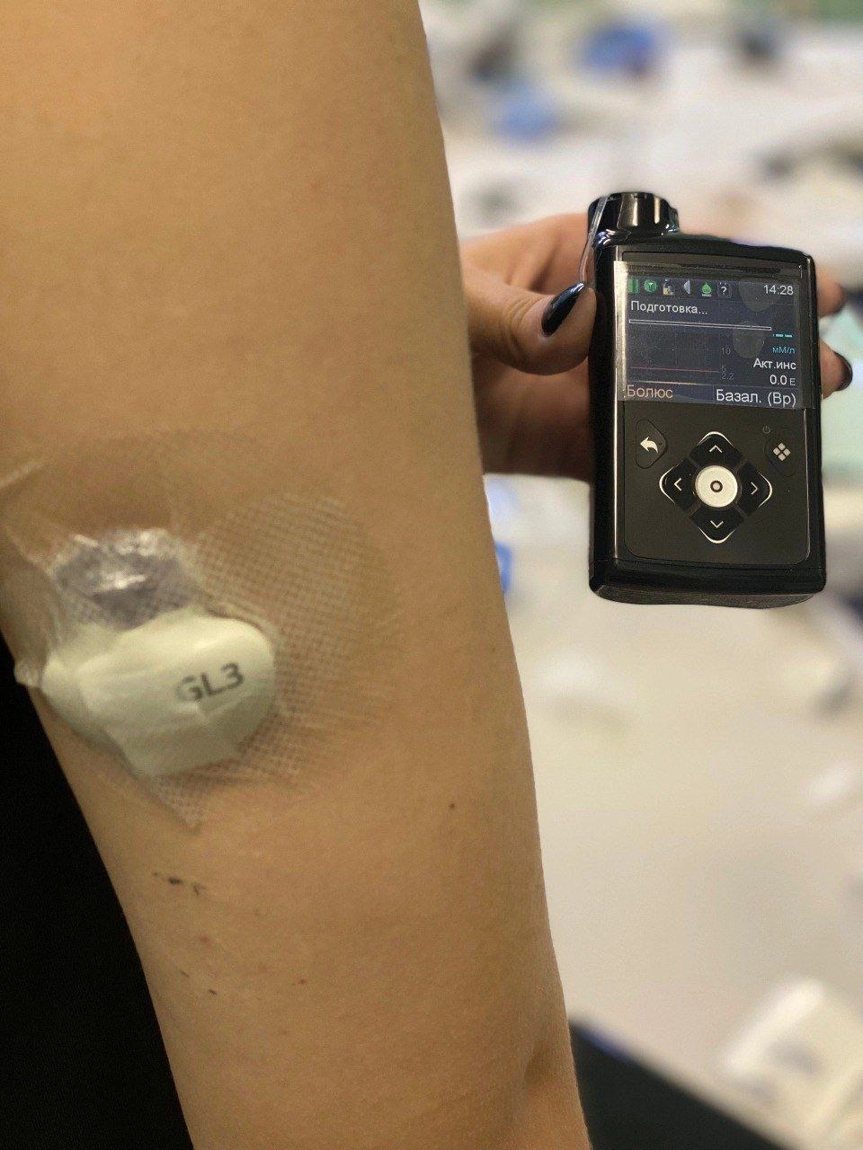 В Псковской области впервые начали устанавливать инсулиновые помпы