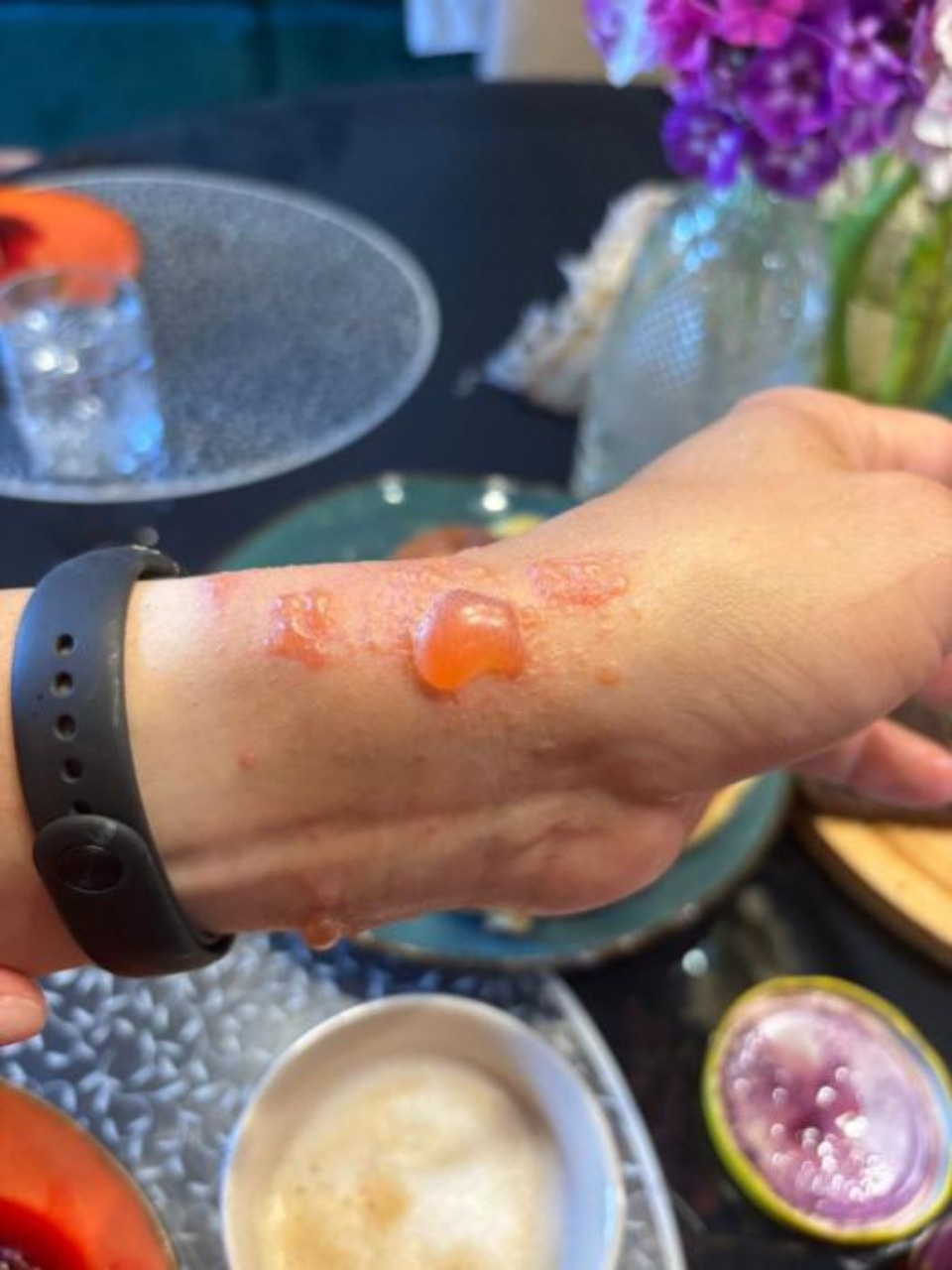 Мужчина получил ожоги при покосе своего участка в Псковском районе