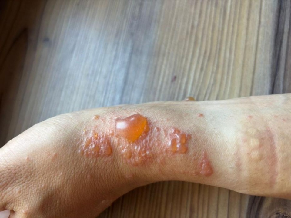 Мужчина получил ожоги при покосе своего участка в Псковском районе