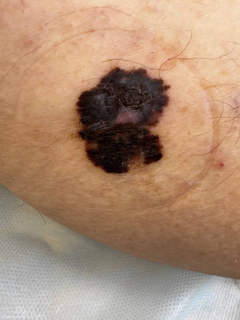 За несколько лет обычная родинка на теле псковички переродилась в меланому