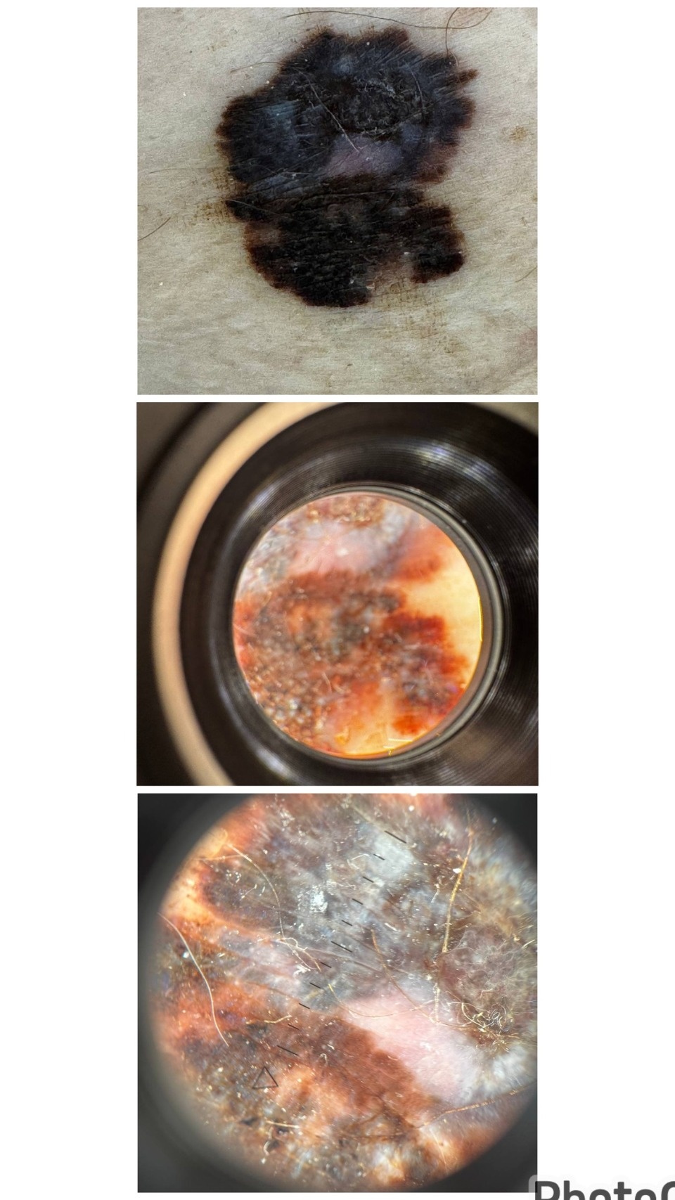 За несколько лет обычная родинка на теле псковички переродилась в меланому