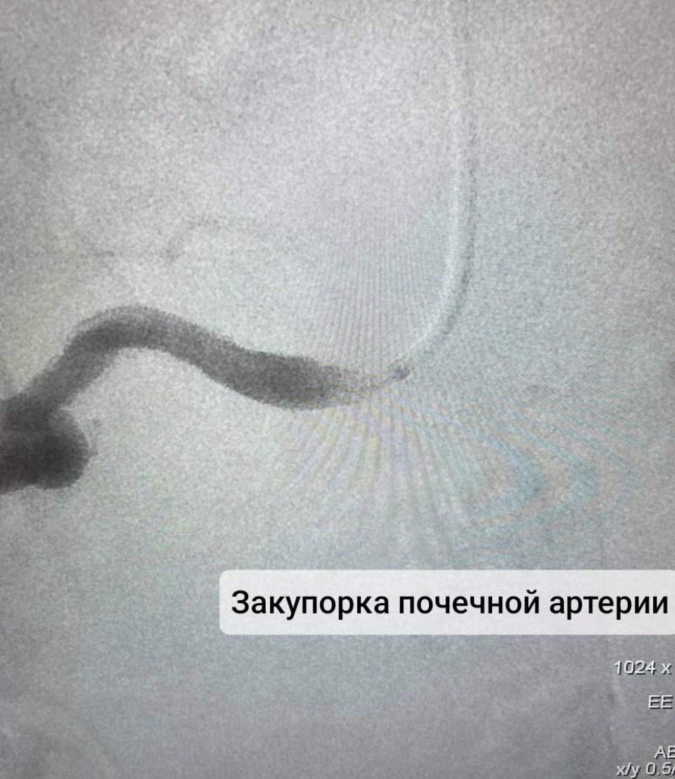 Стентирование почечное артерии впервые провели в Великих Луках