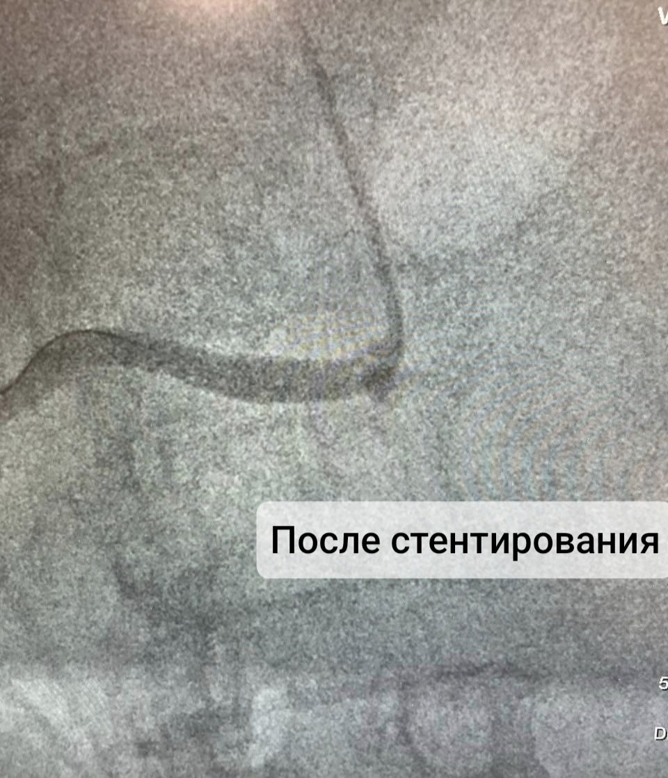 Стентирование почечное артерии впервые провели в Великих Луках