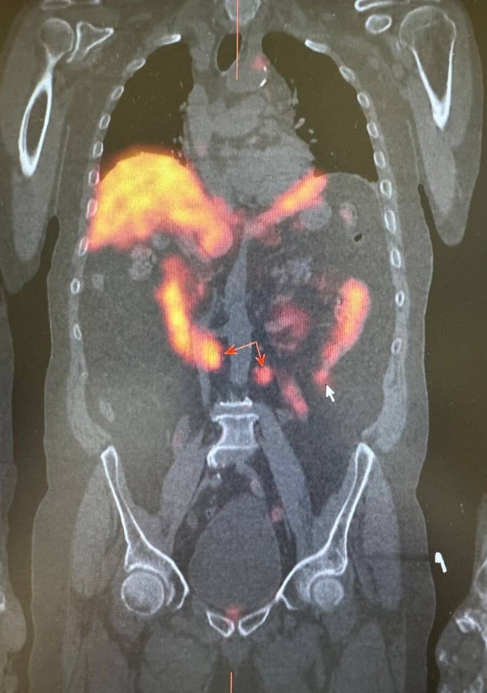 Радионуклидная диагностика позволила обнаружить у псковича скрытые метастазы в лимфоузлах