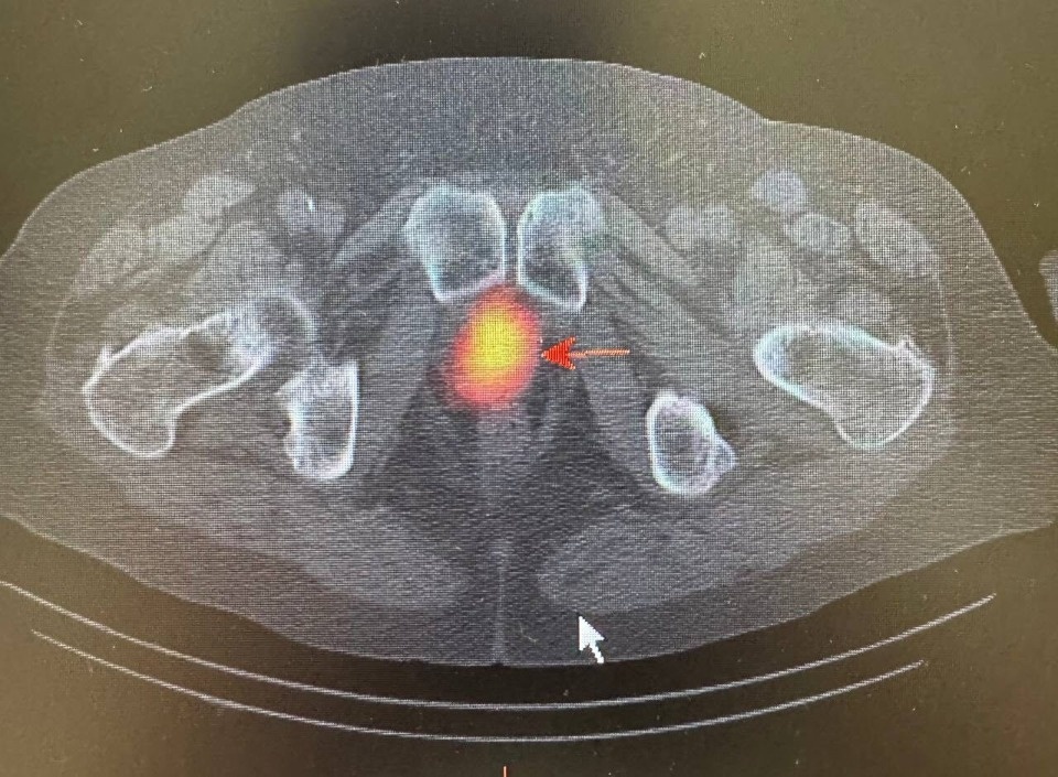 Радионуклидная диагностика позволила обнаружить у псковича скрытые метастазы в лимфоузлах