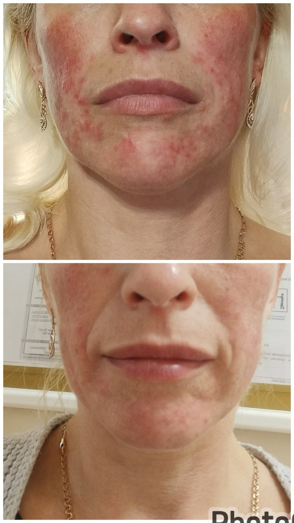 К стероидному дерматиту привело псковичку самолечение от акне