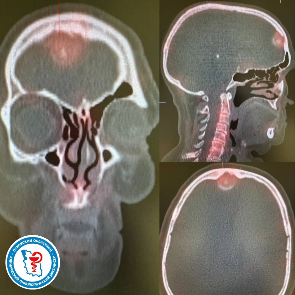  Опухоль мозга вовремя успели обнаружить врачи у лечившейся от рака груди псковички