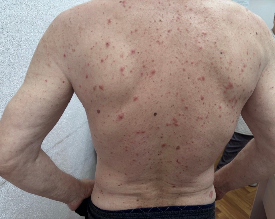 В Псковской области напомнили о нетипичной чесотке у онкобольных